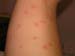 mosquitos5